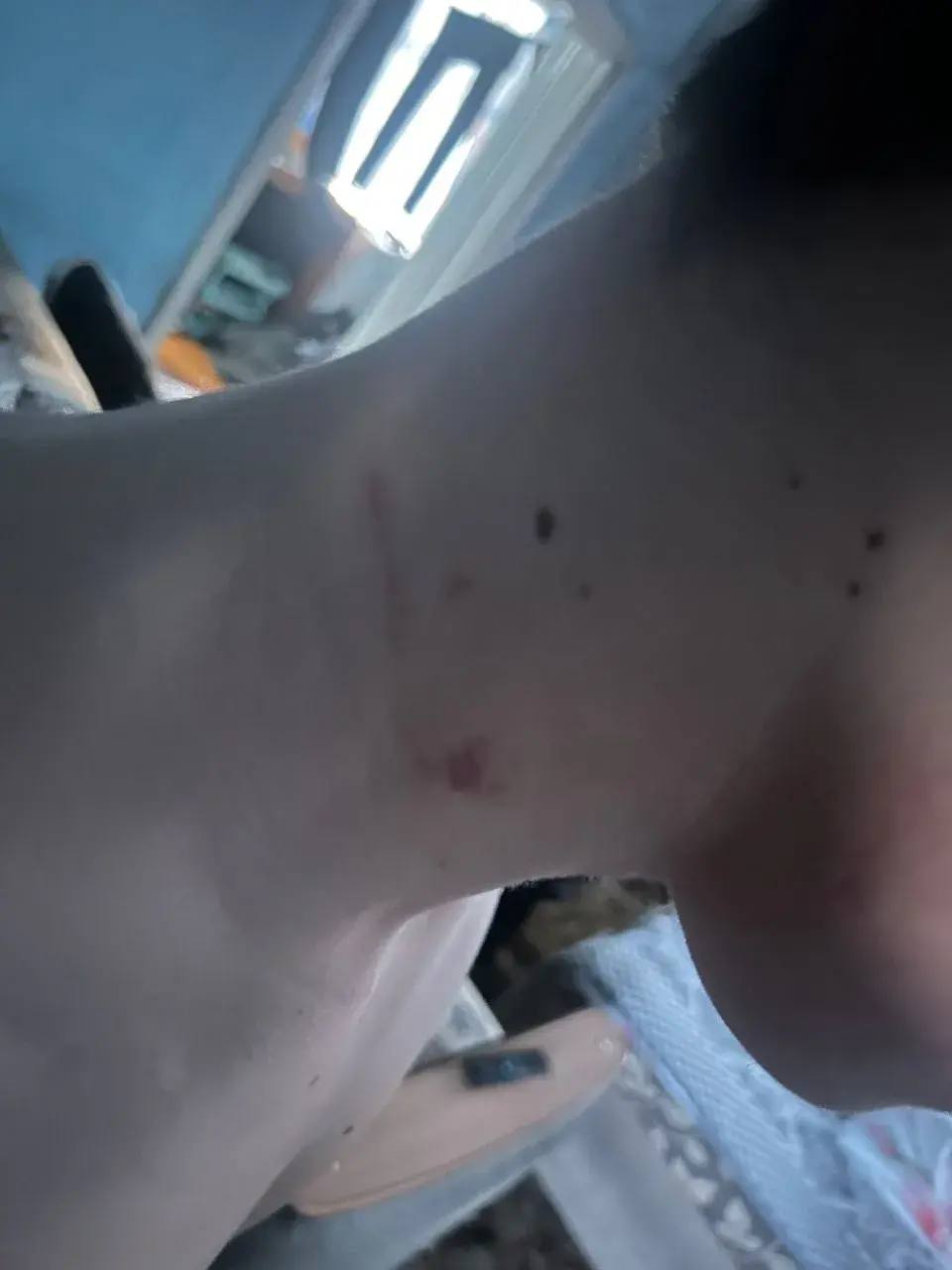 Следы от удушения на шее подростка